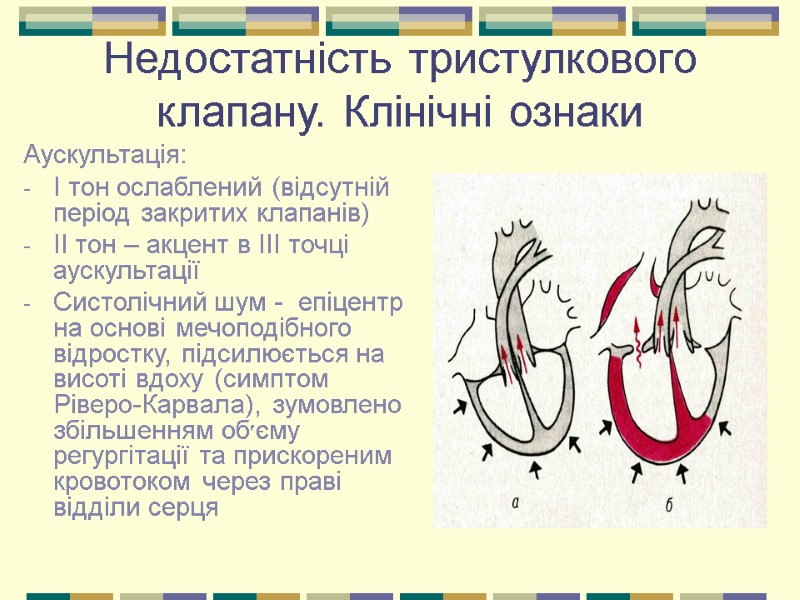 Недостатність тристулкового клапану. Клінічні ознаки Аускультація: І тон ослаблений (відсутній період закритих клапанів) ІІ